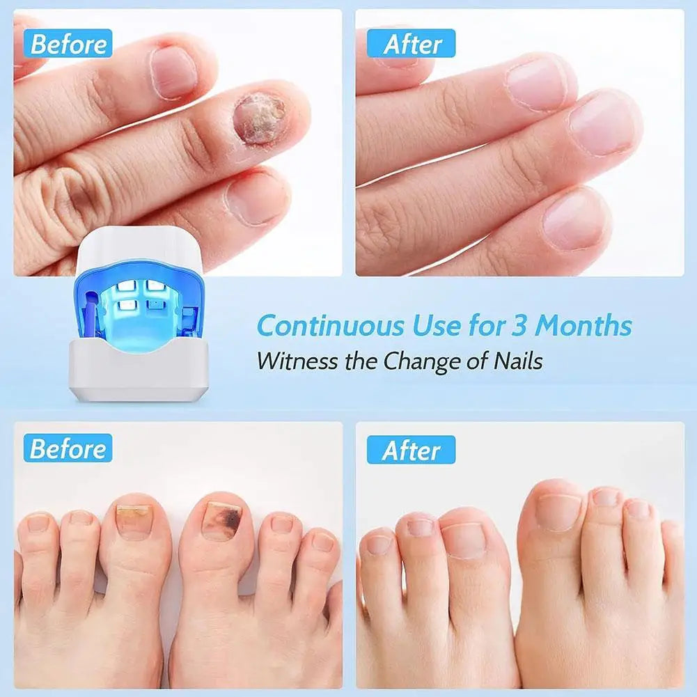 NO FUNGUS ™  O Número 1 contra fungos nas unhas!